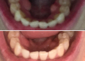 Trina Lower Teeth